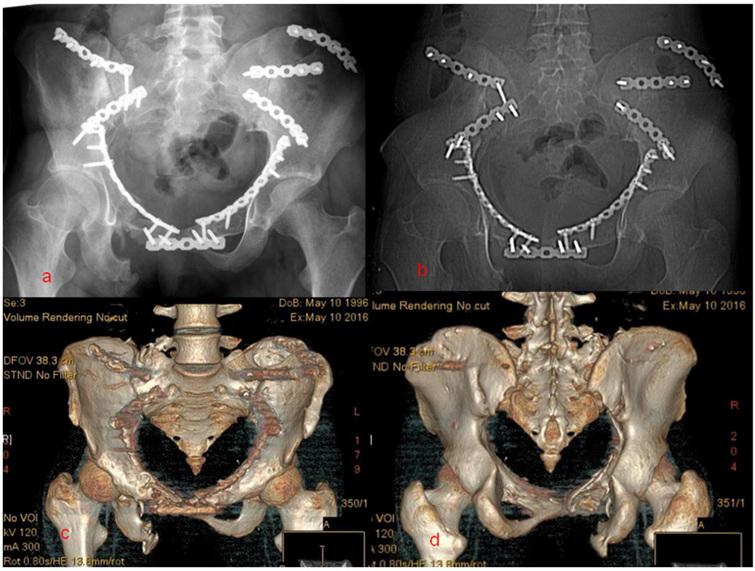 Anterior fracture dislocation of the sacroiliac joint: A case report