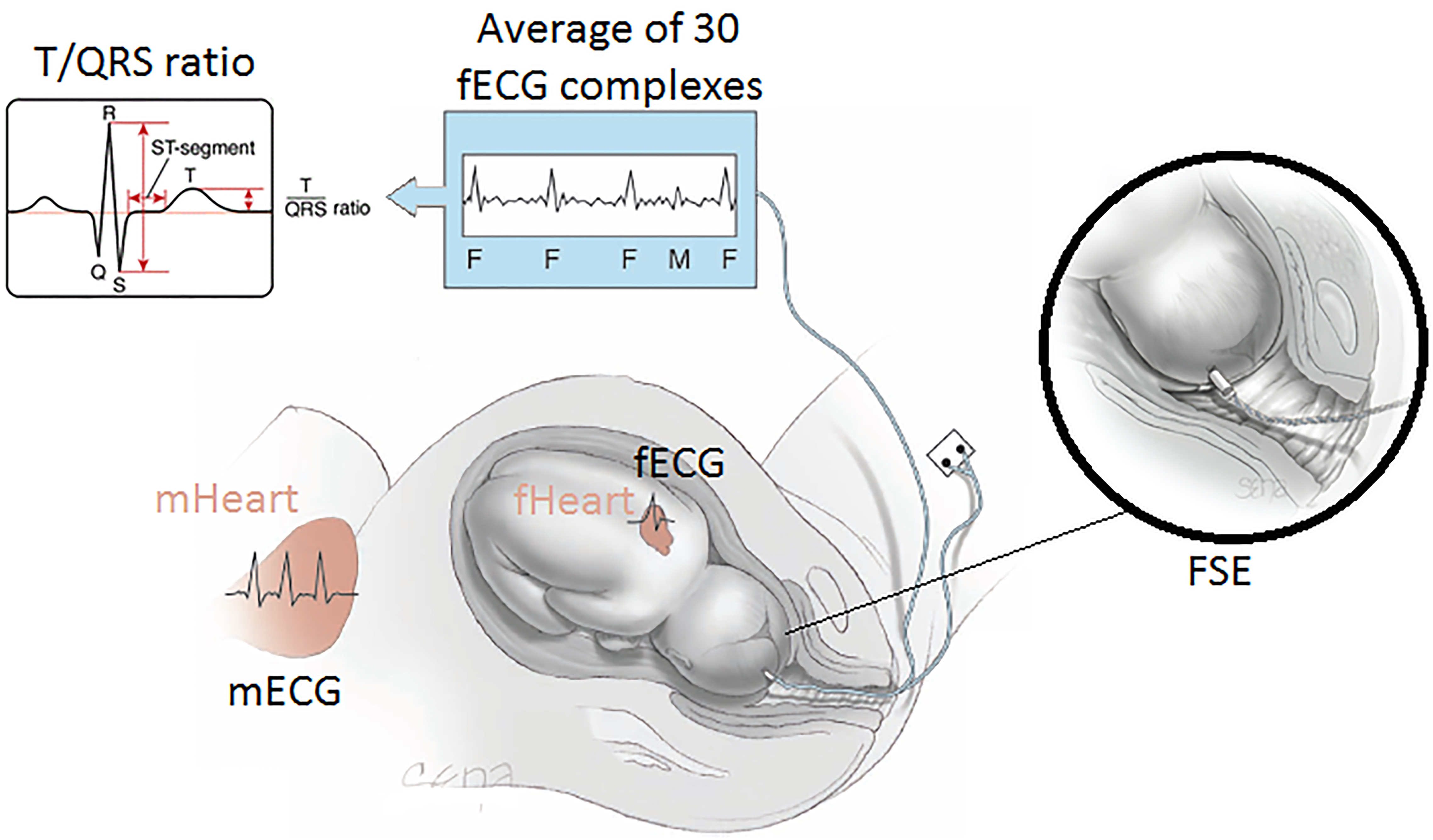 A novel modular fetal ECG STAN and HRV analysis: Towards robust hypoxia ...