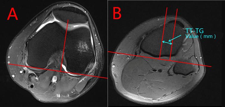 Comparison of Tibial Tuberosity-Trochlear Groove (TT-TG) distances ...