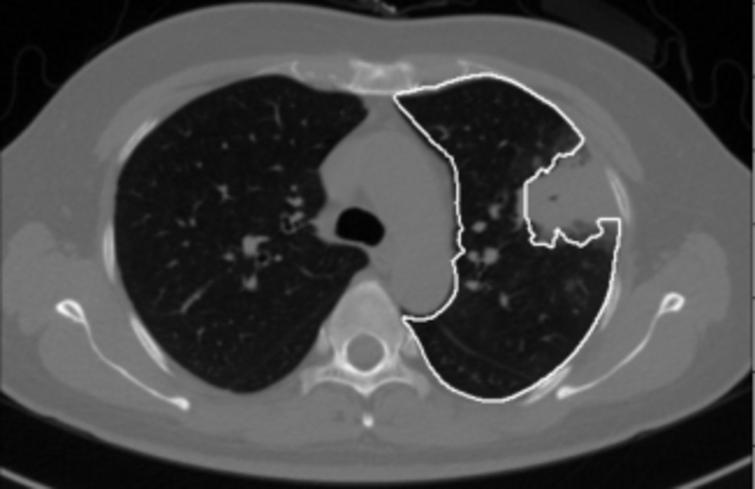 3D segmentation of lungs with juxta-pleural tumor using the improved