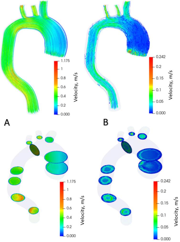 Computational analysis of aortic haemodynamics in the presence of ...