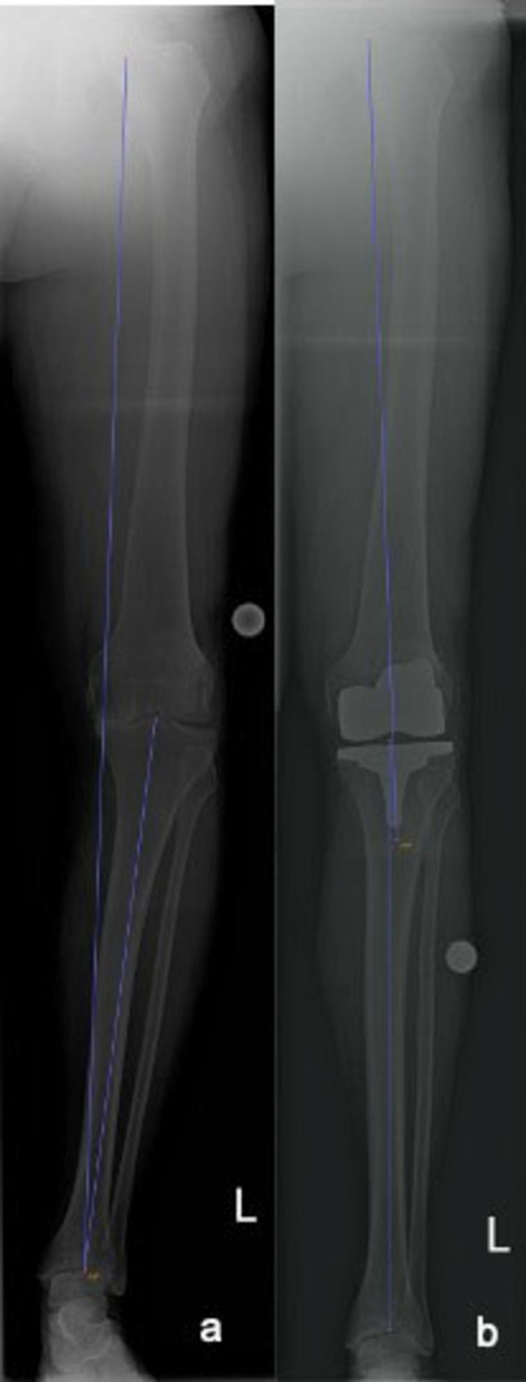 Accuracy of a patient-specific instrumentation for coronal plane ...