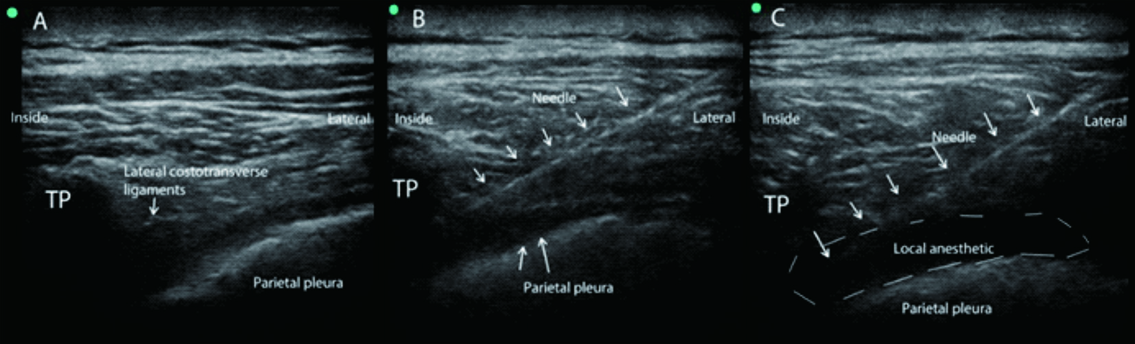 The Median Effective Volume Of Ultrasound Guided Thoracic Paravertebral Nerve Block With 03 5894