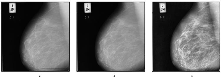 Deep learning-based breast region extraction of mammographic images ...