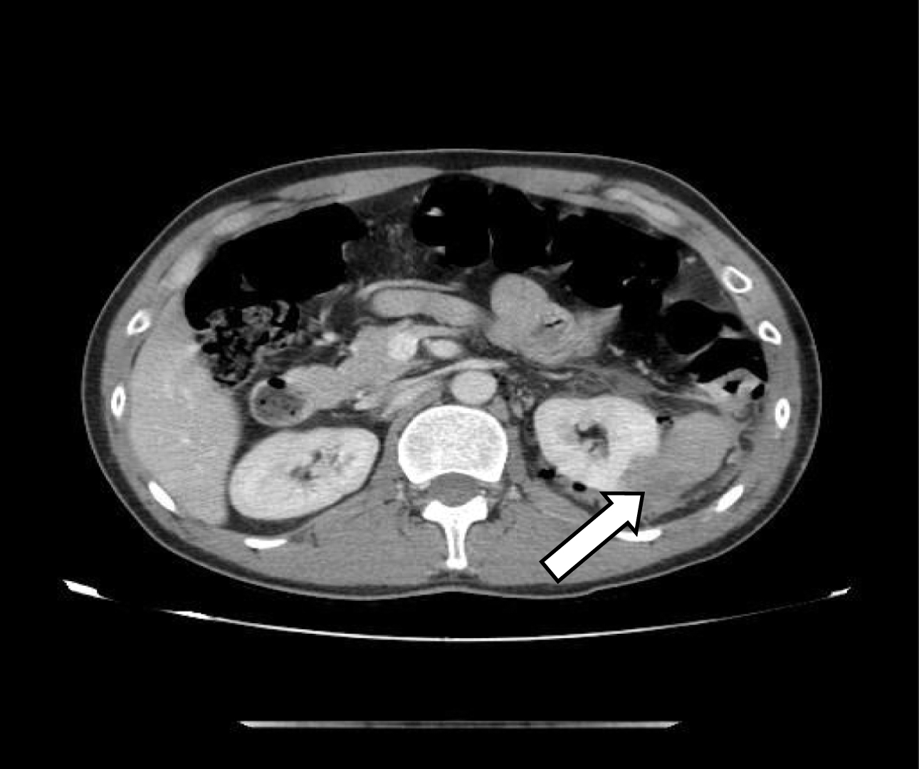 Diagnosis Value Of Multi-slice Spiral CT In Renal Trauma - IOS Press