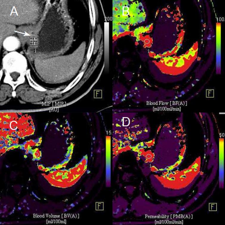 The feasibility of low-dose CT perfusion imaging in gastric cancer ...