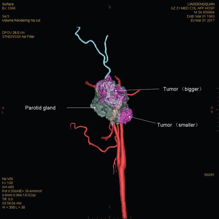 Diagnosis Of Lymphoepithelial Carcinoma In Parotid Gland With Three