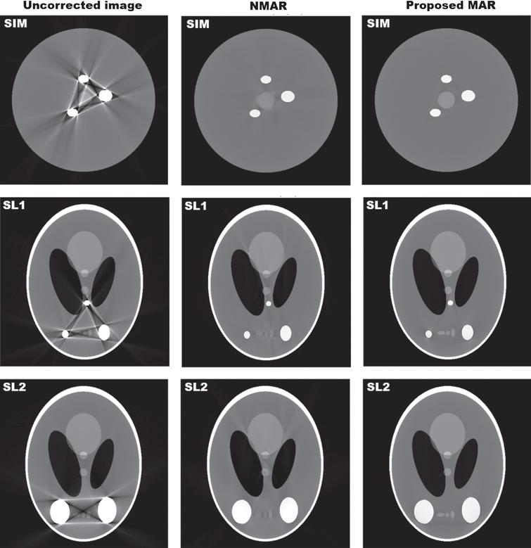 A CT metal artifact reduction algorithm based on sinogram surgery - IOS ...