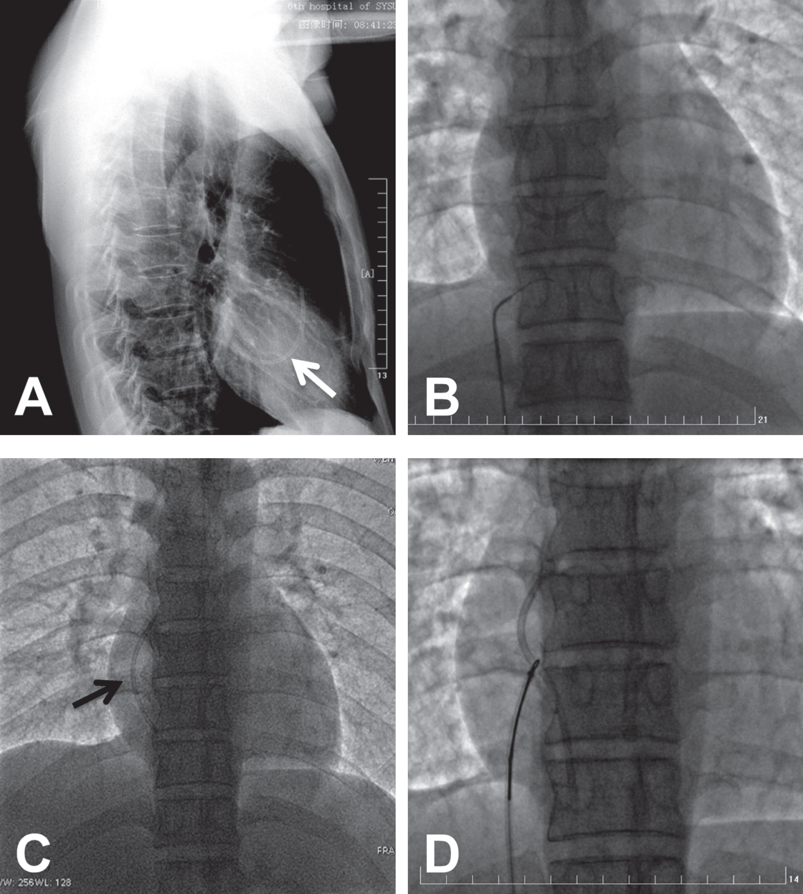 Successfully removed fragment of dislodged chemoport catheter