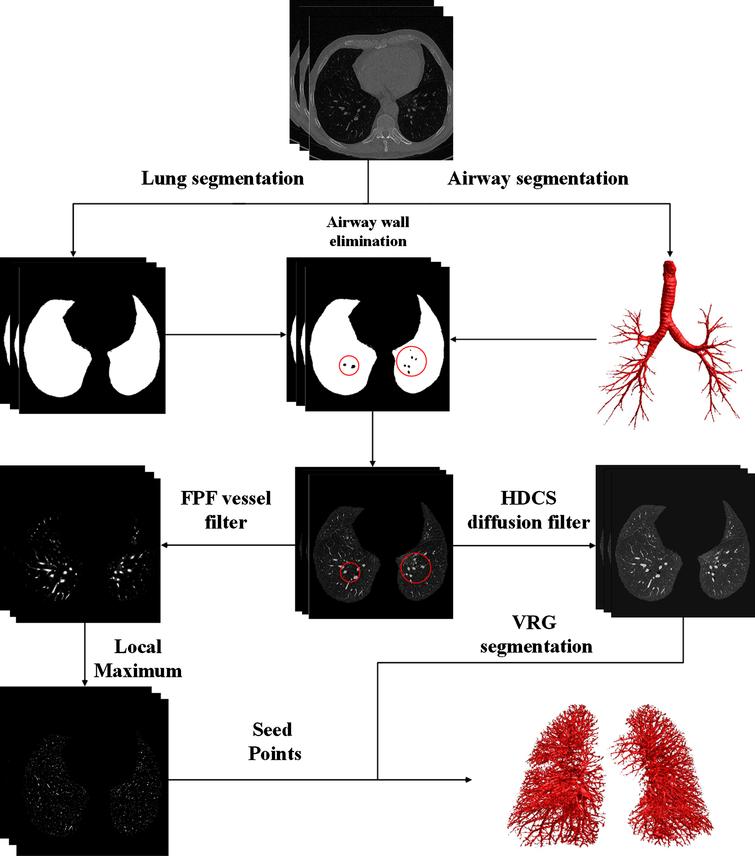 Pulmonary Artery Tree