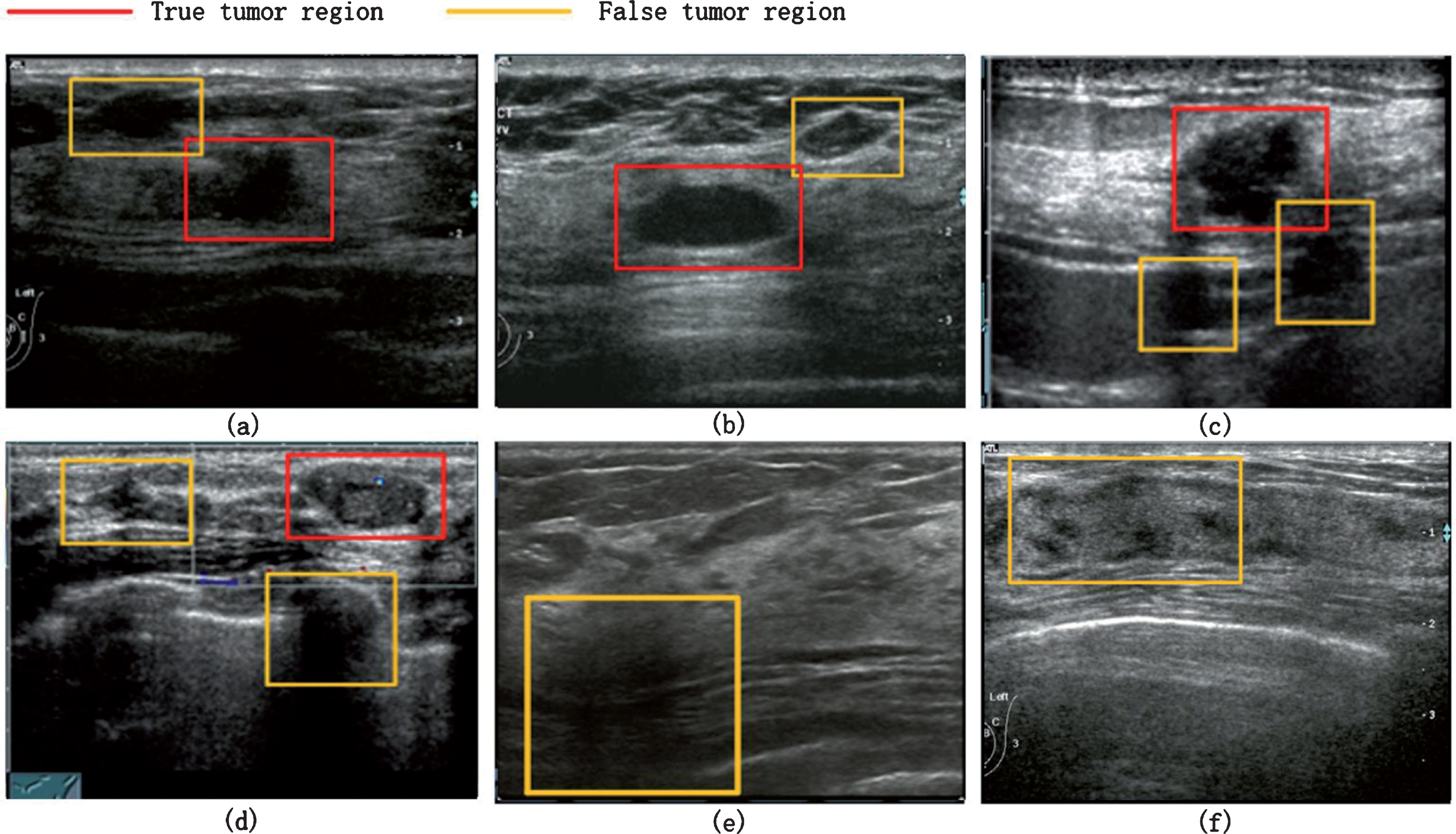 New one-step model of breast tumor locating based on deep learning ...