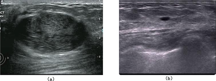 New one-step model of breast tumor locating based on deep learning ...