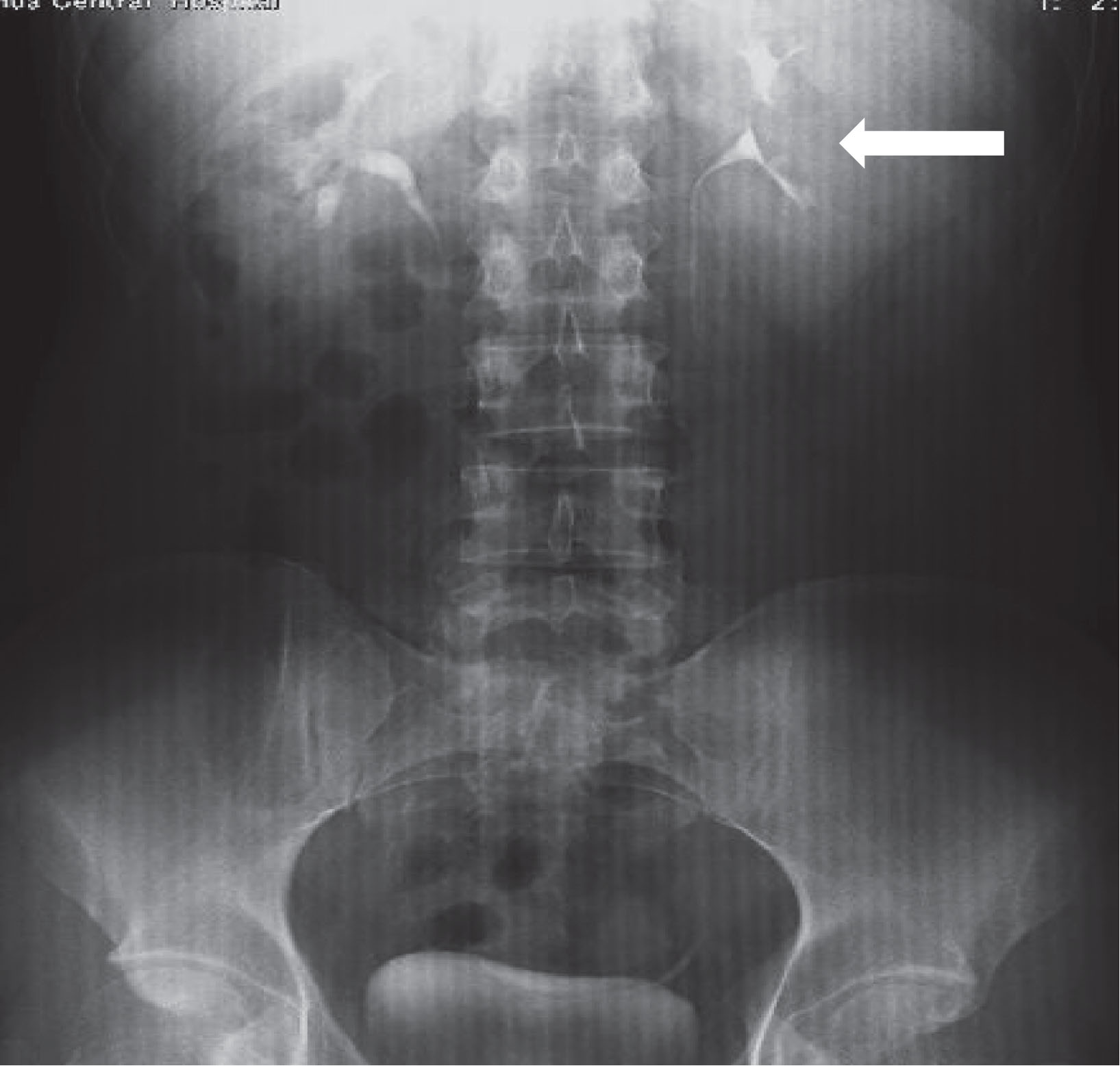 Challenges in the diagnosis of calyceal diverticulum: A report of two ...