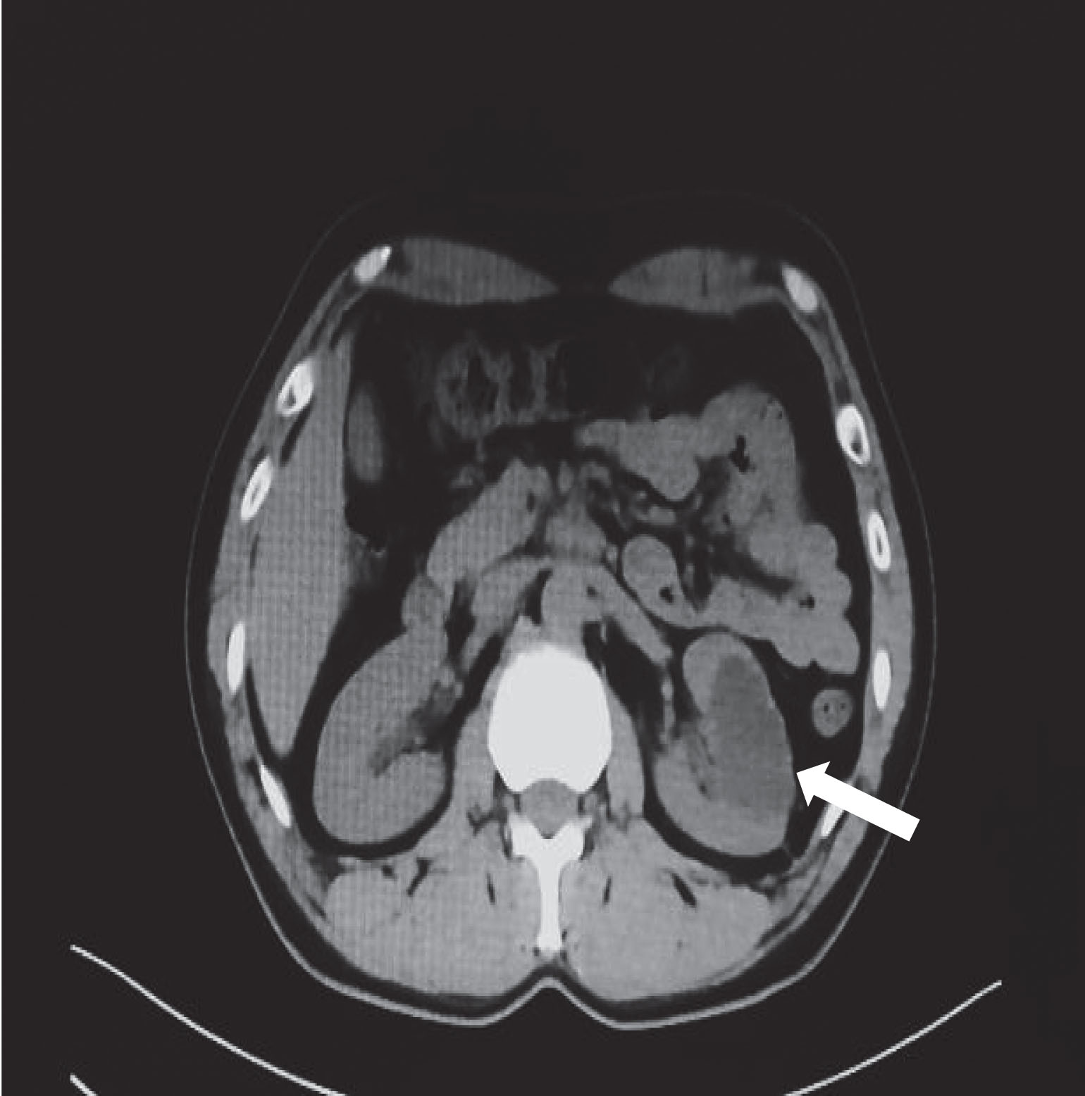 Challenges In The Diagnosis Of Calyceal Diverticulum: A Report Of Two 