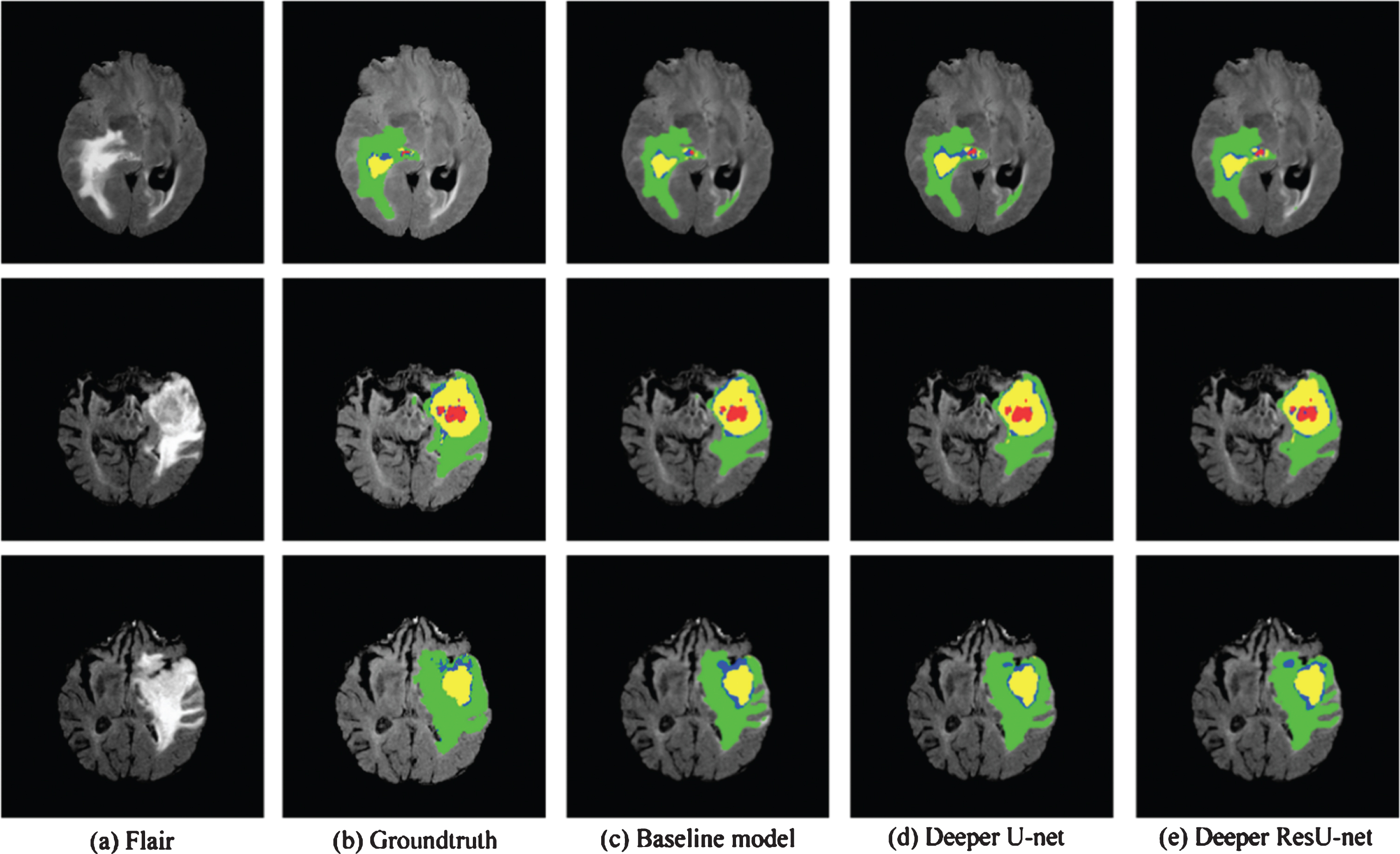 PDF] Brain Tumor Segmentation of MRI Images Using Processed Image Driven  U-Net Architecture