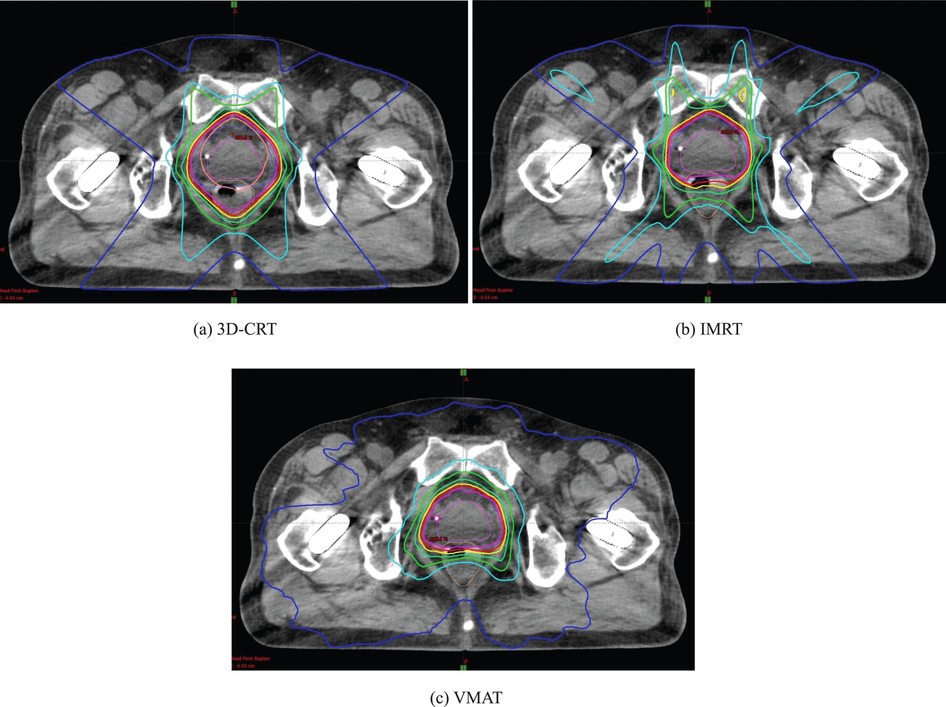 Evaluation of geometrical uncertainties on localized prostate ...