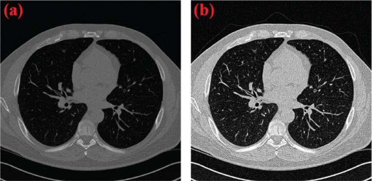 A quality improvement method for lung LDCT images - IOS Press