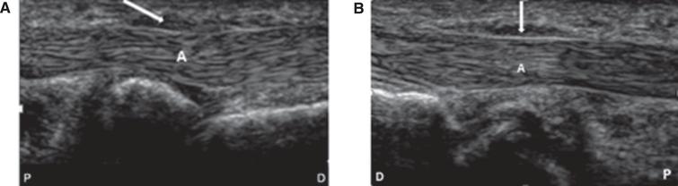 Comparison of the clinical effectiveness of ultrasound-guided ...