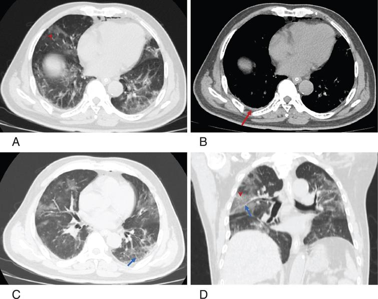 Clinical and computed tomographic (CT) images characteristics in the ...