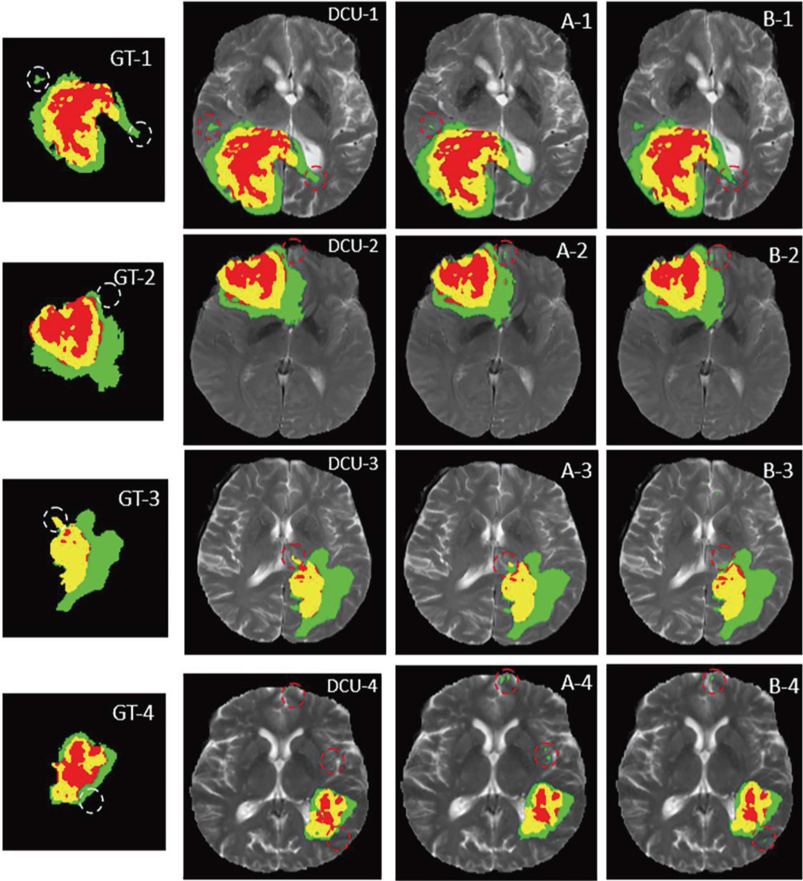 PDF] Brain Tumor Segmentation of MRI Images Using Processed Image Driven  U-Net Architecture