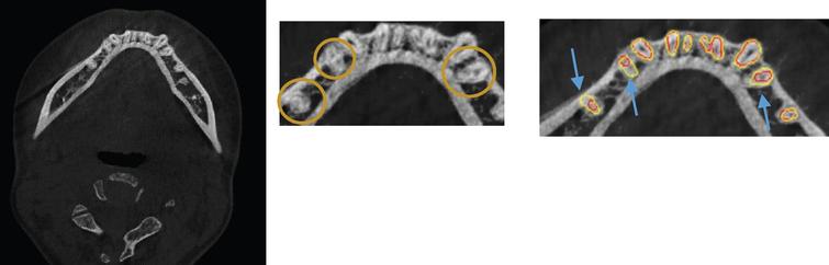 Automatic tooth roots segmentation of cone beam computed tomography ...