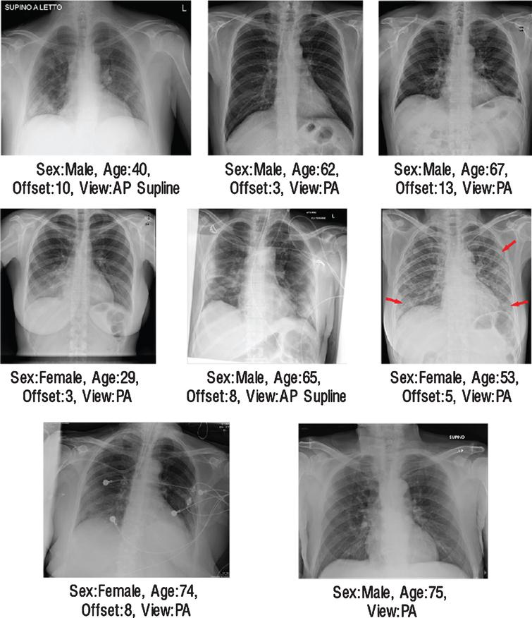 COVID-19 diagnosis from chest X-ray images using transfer learning ...