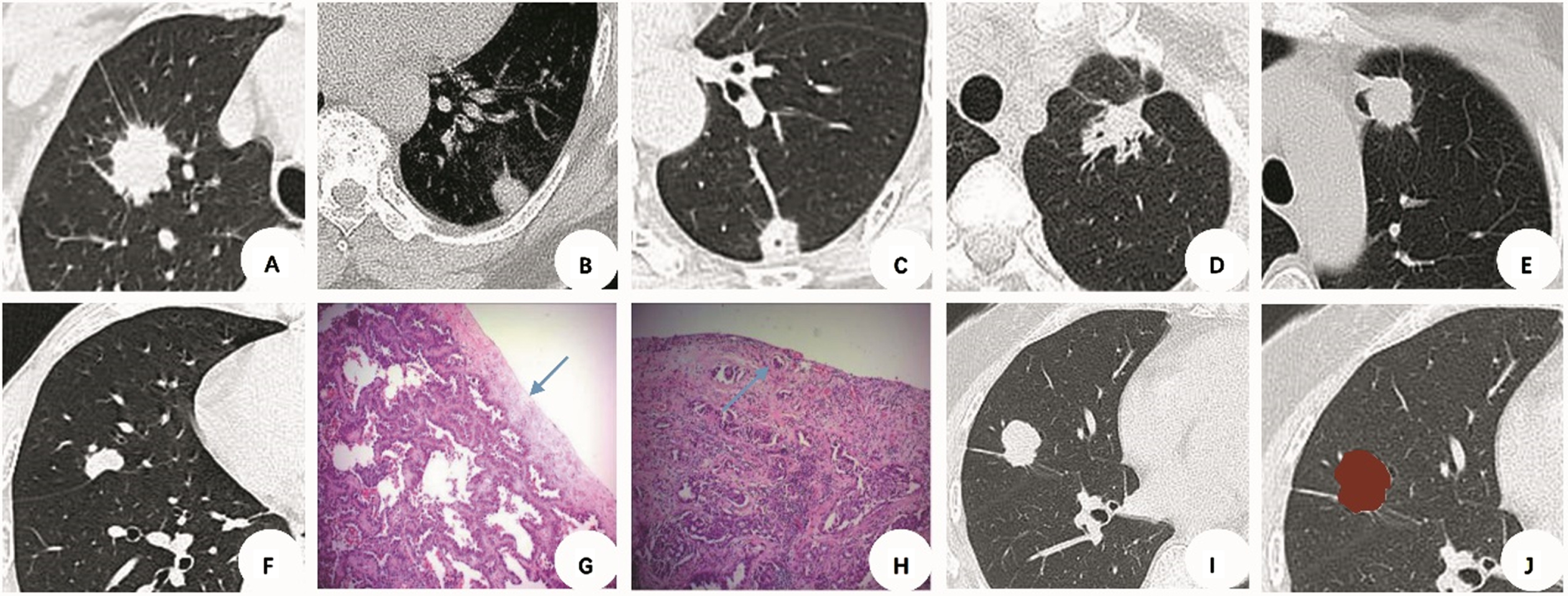 The value of CT radiomics features to predict visceral pleural invasion ...