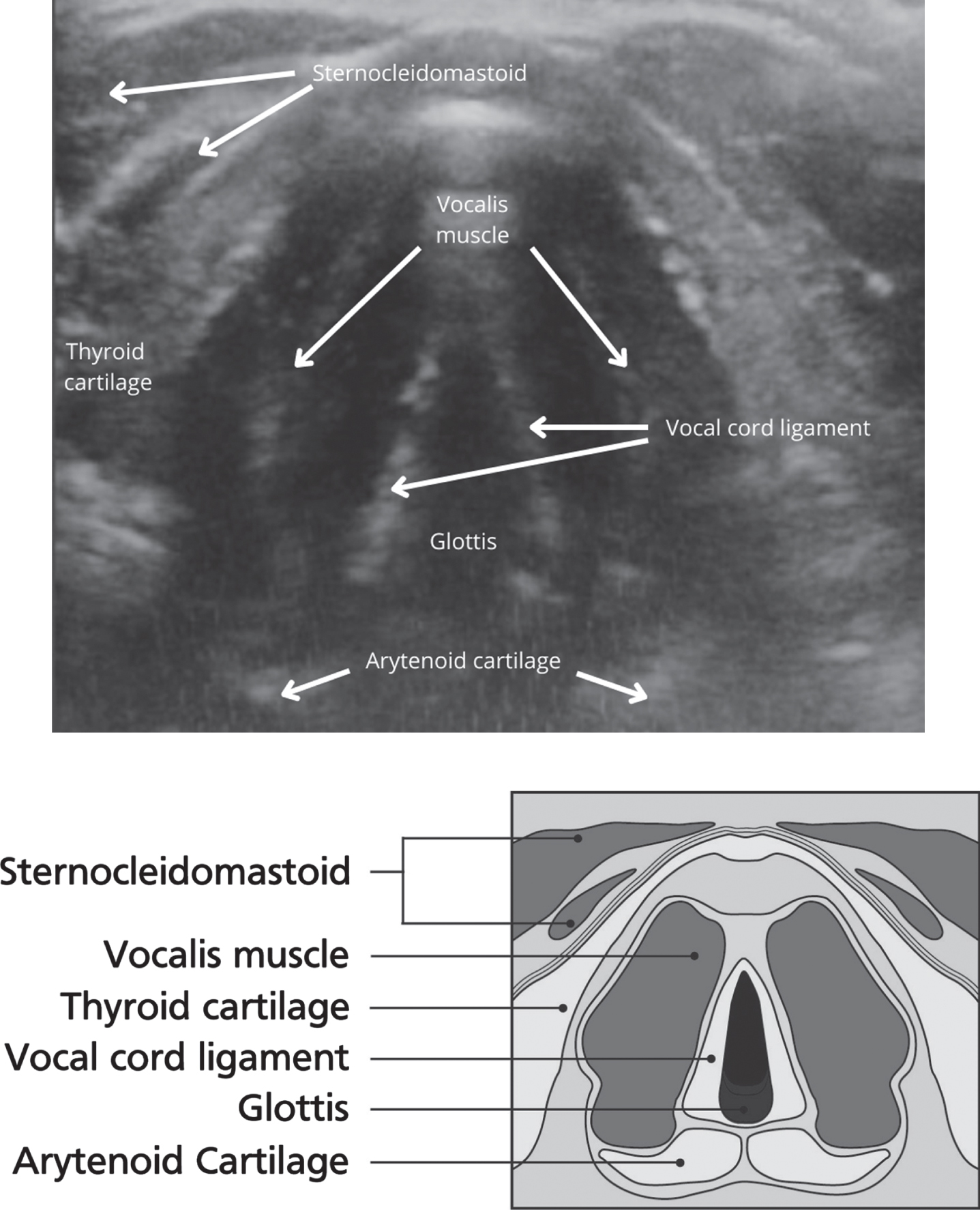 Images of Vocal folds using ultrasound and schematic diagram.