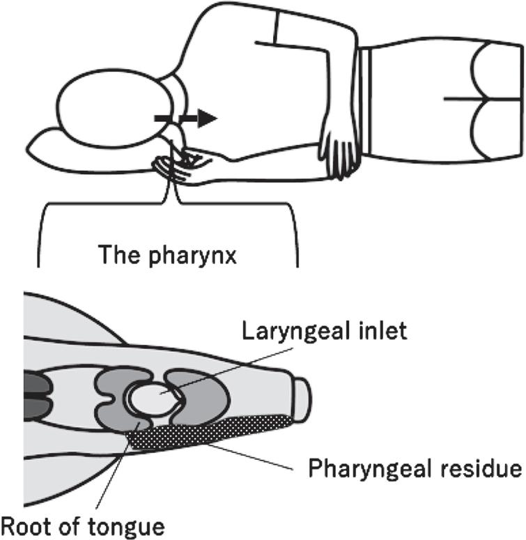 The side-lying posture. Bolus flows to the functional side of the pharynx (the dashed arrow) and can be held in the hypopharynx (the dotted area) without overflowing to the larynx. At the same time, the patient attempts to clear the residue with additional dry swallows.