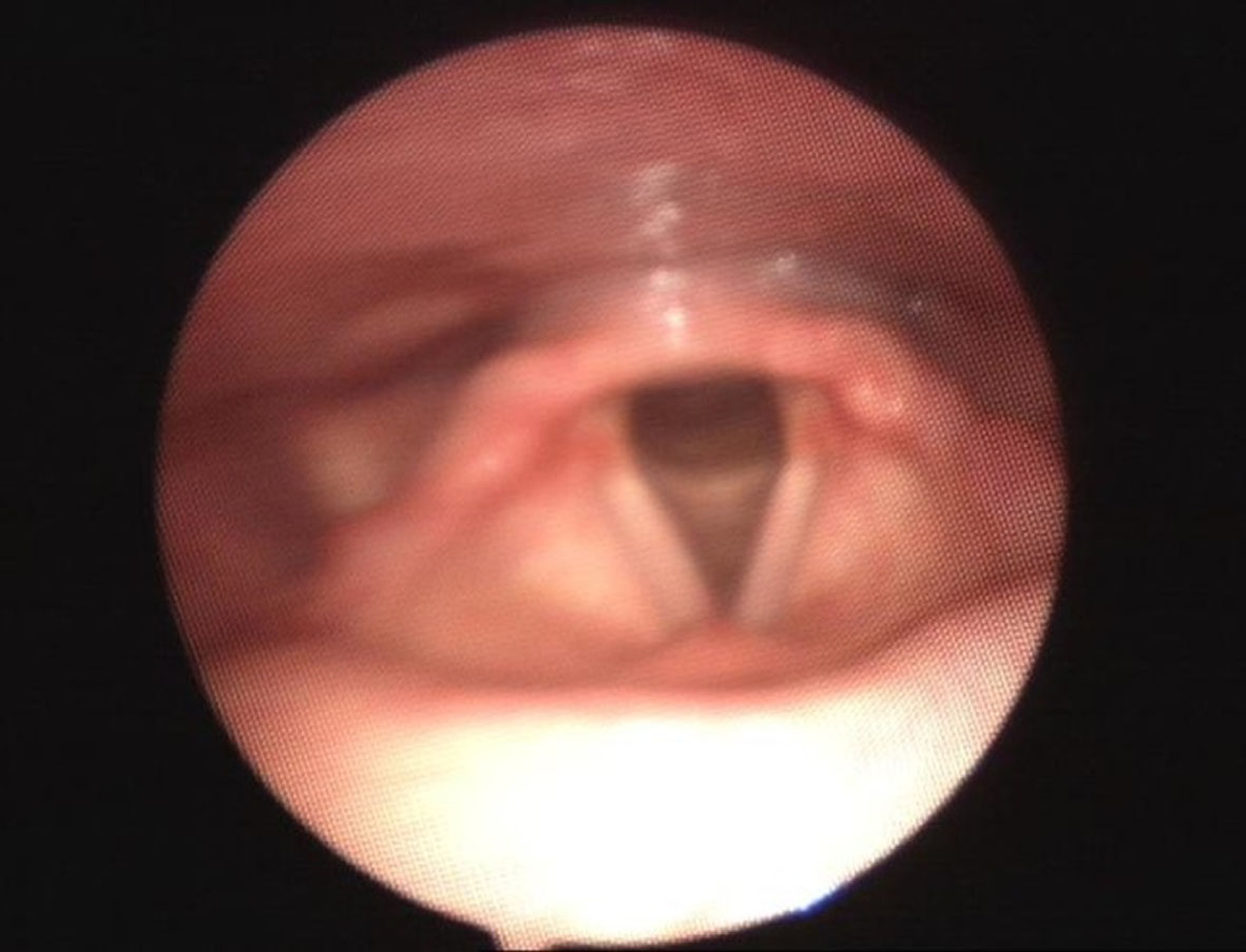 Larynx during normal breathing.