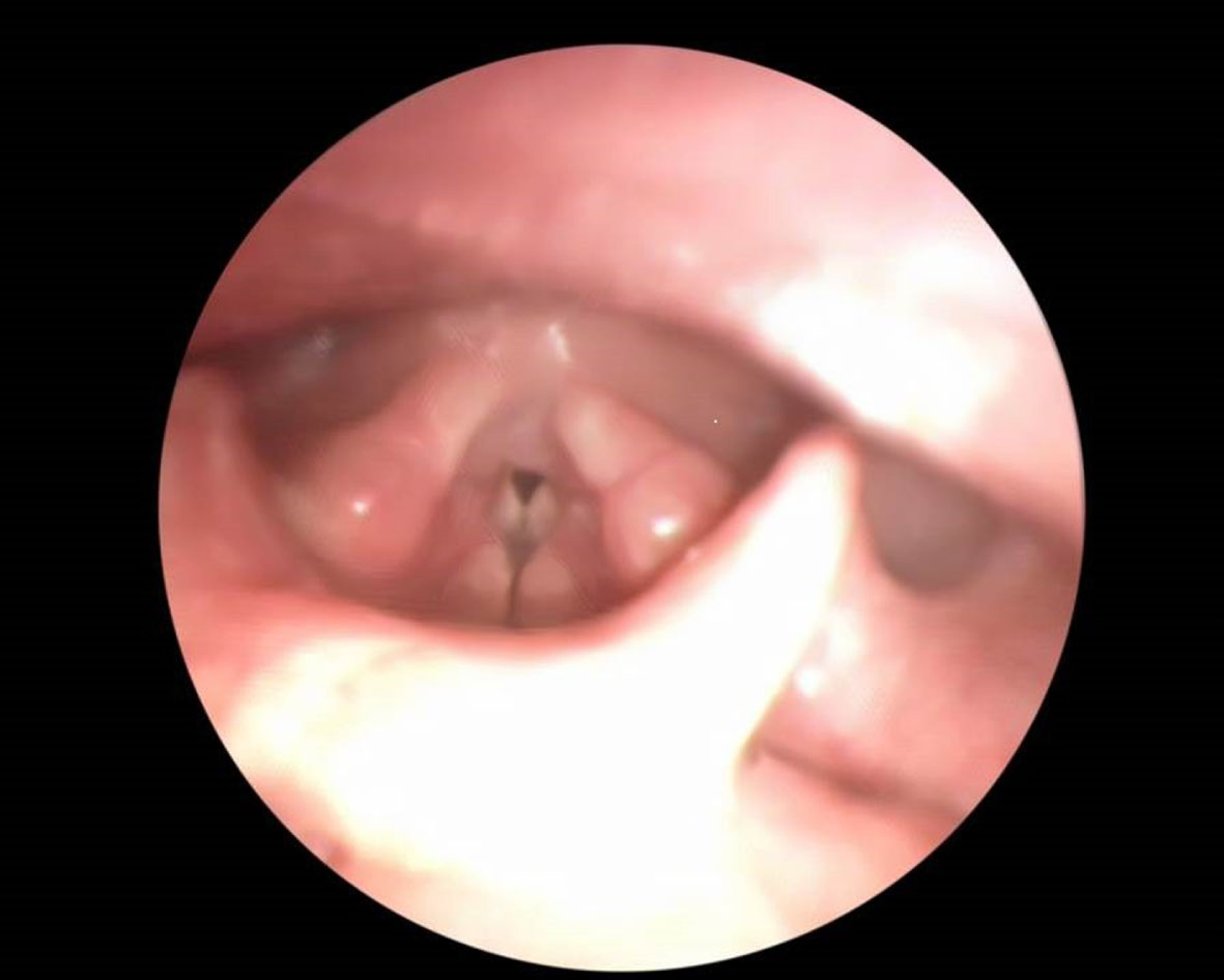 Larynx demonstrating Inducible Laryngeal Obstruction.