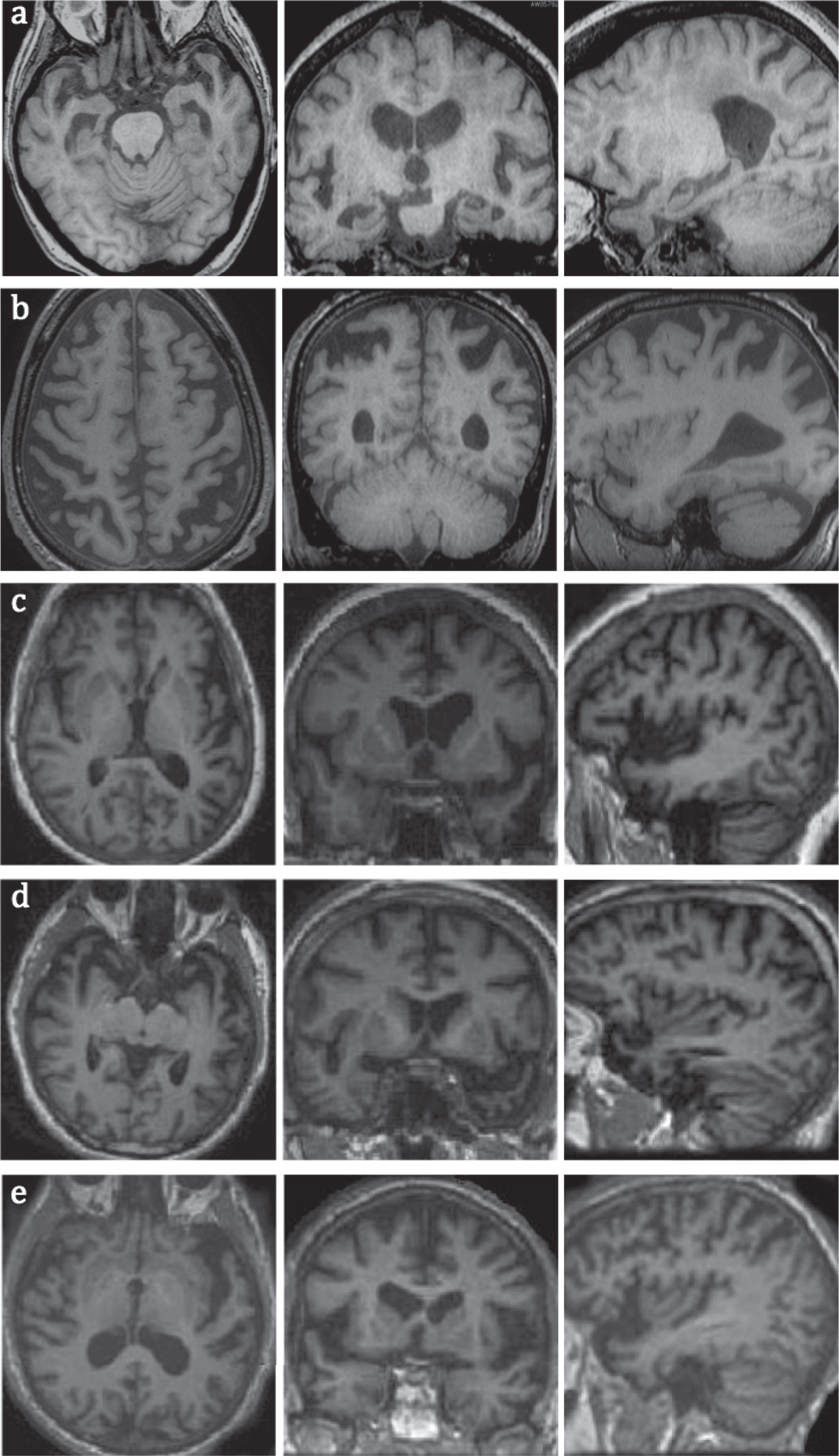 MRI images of common types of dementia in axial, coronal, and sagittal planes, a) early AD with hippocampal and MTL atrophy; b) PCA with superior posterior parietal lobes atrophy; c) logopenic variant of PPA with atrophy in left temporoparietal junction; note more prominent left sided atrophy of posterior and lateral temporal lobes; d) semantic variant of PPA with atrophy in anterior and lateral temporal lobes; e) non-fluent variant of PPA with left frontal operculum and insular atrophy.