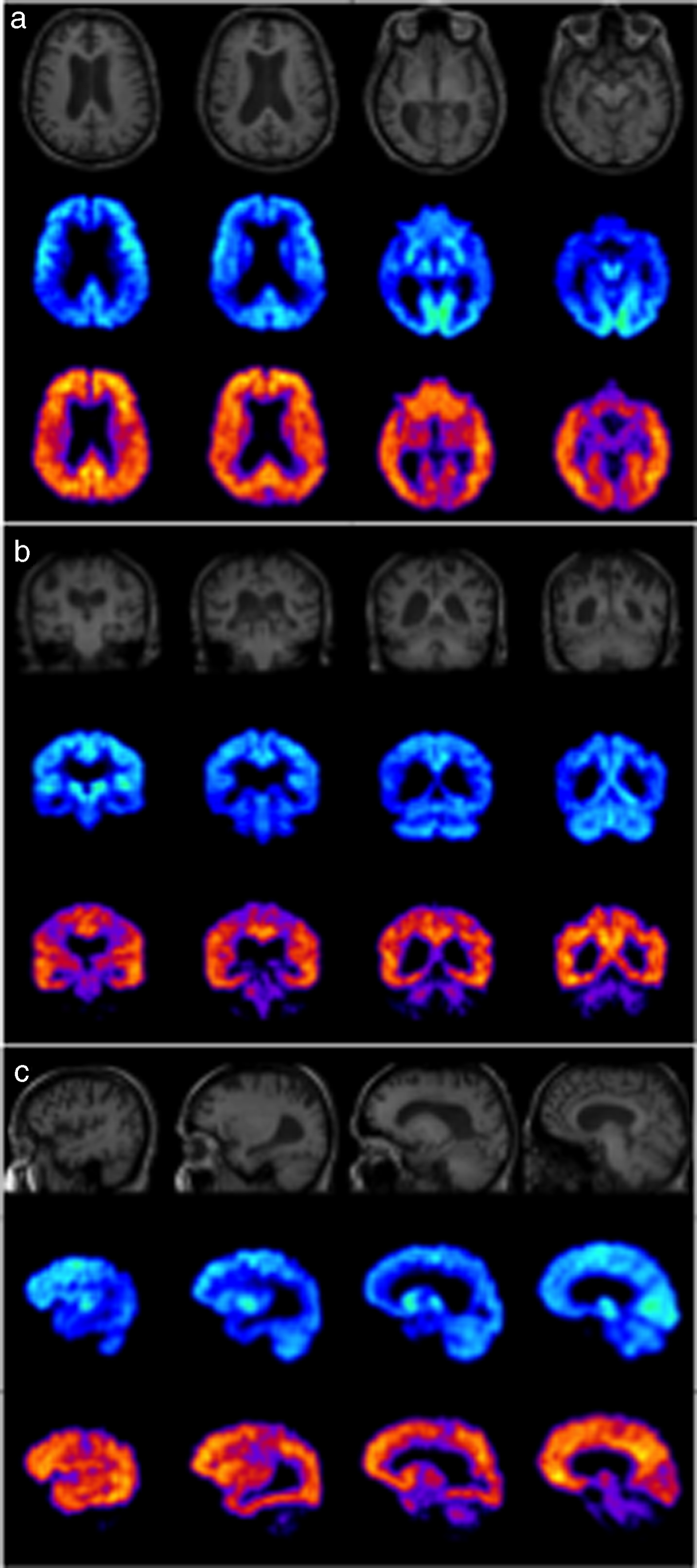 MRI (top), FDG-PET (middle), and PiB-PET (bottom) images of a typical AD case in axial (a), coronal (b) and sagittal (c) planes showing hypometabolism in parietal and temporal lobes in FDG-PET and extensive cortical amyloid deposition in PiB-PET.