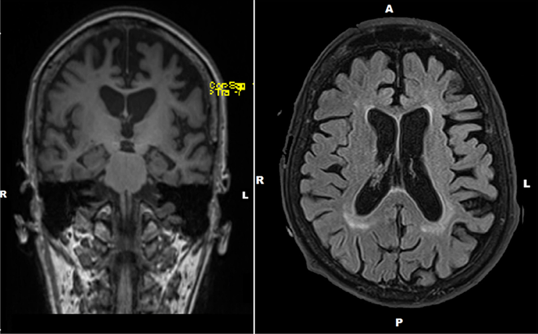 Preoperative brain MRIs (left: coronal view; right: sagittal view) of the patient. MRI brain scan revealed diffuse cortical atrophy; the frontal and temporal lobes were the most affected, predominantly on the left side.