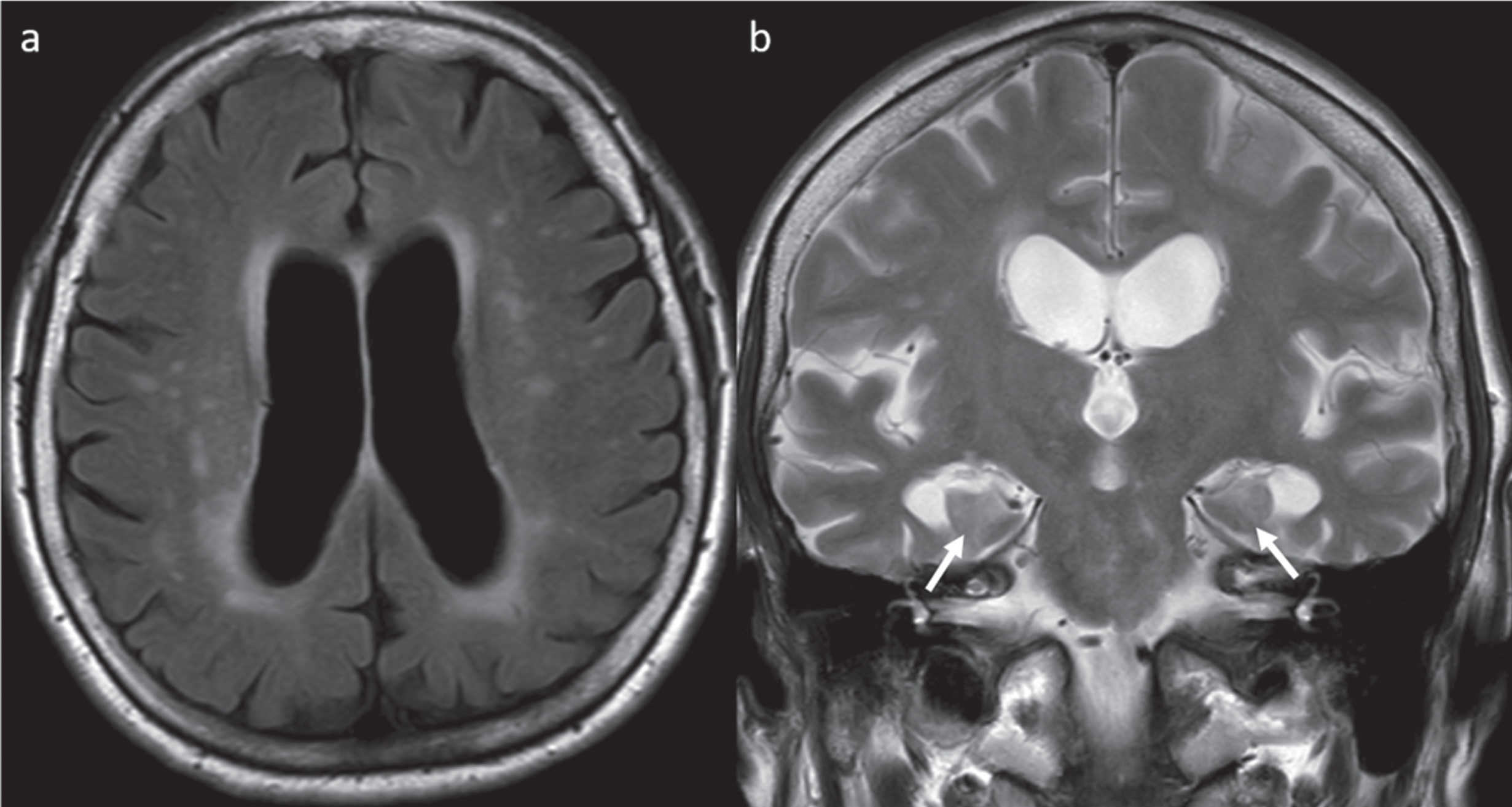 MRI of the brain demonstrating mild-moderately enlarged lateral ventricles. a) Axial T2-weighted FLAIR demonstrating periventricular foci of prolonged T2 signal as well as scattered foci of T2 signal abnormalities compatible with small vessel ischemic disease. b) Coronal T2-weighted image demonstrating atrophy of the mesial temporal structures (arrows indicate diminished size of the hippocampi).