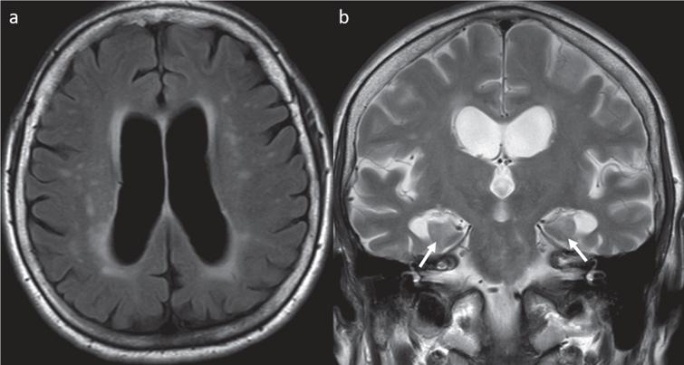 MRI of the brain demonstrating mild-moderately enlarged lateral ventricles. a) Axial T2-weighted FLAIR demonstrating periventricular foci of prolonged T2 signal as well as scattered foci of T2 signal abnormalities compatible with small vessel ischemic disease. b) Coronal T2-weighted image demonstrating atrophy of the mesial temporal structures (arrows indicate diminished size of the hippocampi).