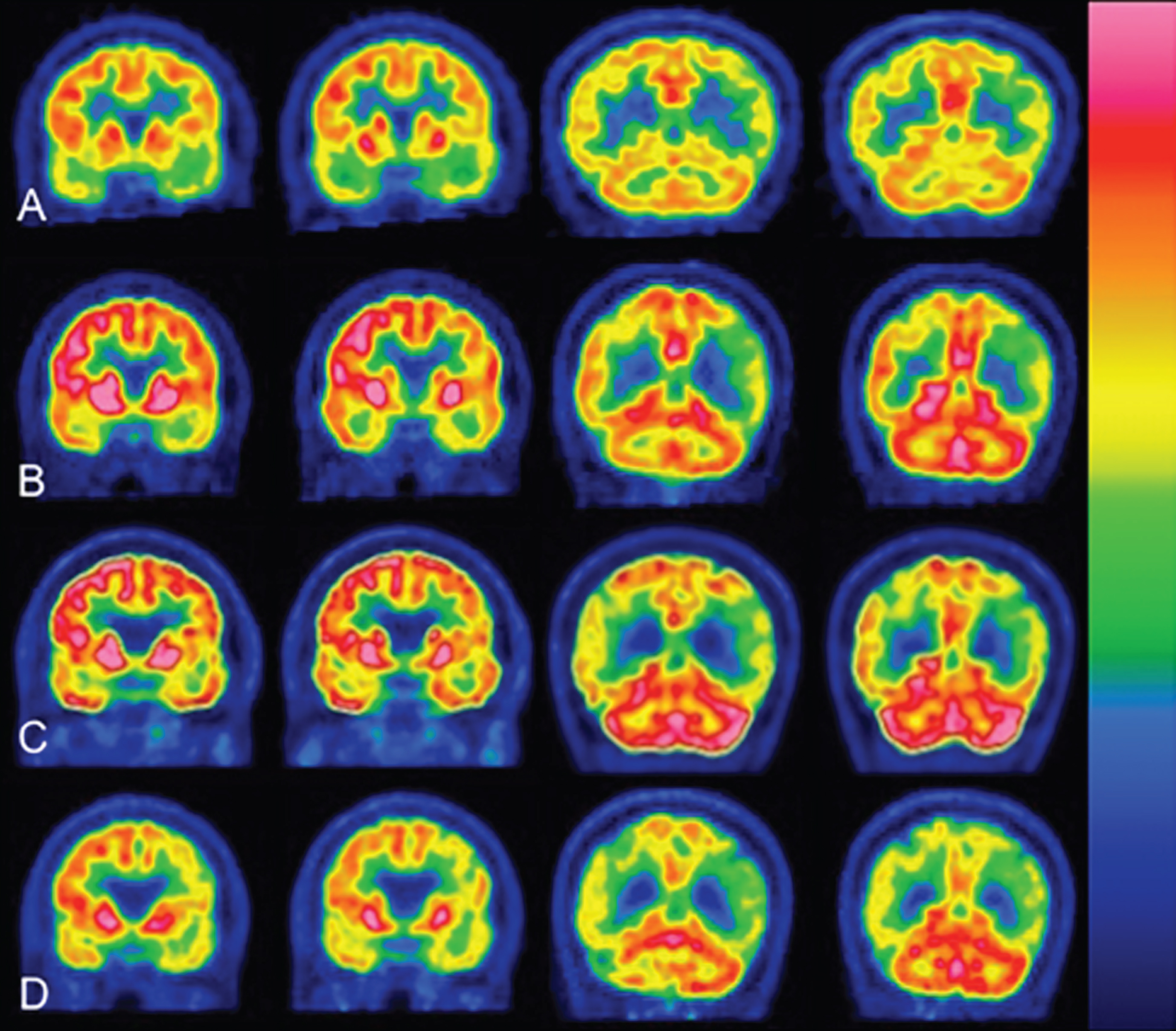 18 FDG PET-scan coronal sections. Matching of representative coronal sections showed a significant increase in the brain metabolism during NGF-treatment (10 μl NGF daily). Flame scale indicates FDG use/100 g tissue/min. Red color indicates more FDG-use than blue. A) Before treatment, note the FDG-uptake reduction in the following brain areas: frontotemporal lobes left>right, basal ganglia, cerebellum and occipital lobes. B) After 3 months of NGF-treatment (5 μl NGF per nostril daily), note a significant increase in FDG-uptake (p <  0.05) in the following brain areas: frontotemporal lobes, thalamus, basal ganglia, occipital lobes, cerebellum, and dentate nucleus. C) After 1 year of NGF-treatment (5 μl NGF per nostril daily), the PET scans showed further enhancement of FDG-uptake (p <  0.05) in the same brain areas as in (B) and also in the parahippocampal areas. D) After 1 year of stopping NGF-treatment, the brain areas showed a significant reduction in global activities.
