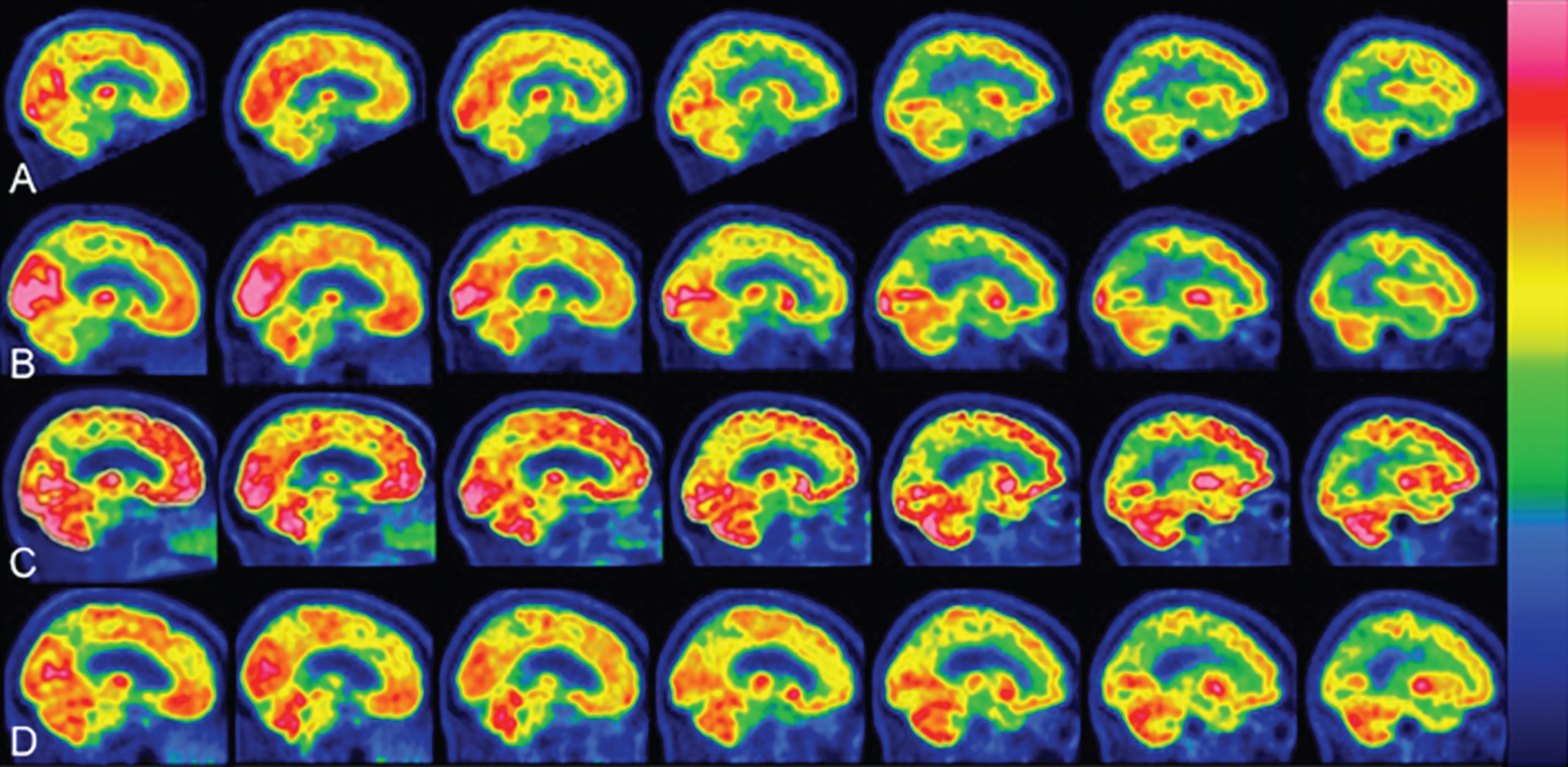 18 FDG PET-scan sagittal sections. Matching of representative sagittal sections showed a significant increase in the brain metabolism during NGF-treatment (10 μl NGF daily). Flame scale indicates FDG use/100 g tissue/min. Red color indicates more FDG-use than blue. A) Before treatment, note FDG-uptake reduction in the following brain areas: frontotemporal lobes left>right, basal ganglia, cerebellum. B) After 3 months of NGF-treatment (5 μl NGF per nostril daily), note a significant increase in FDG-uptake (p <  0.05) in the occipital and frontotemporal lobes. C) After 1 year of NGF-treatment (5 μl NGF per nostril daily), the PET scans showed further enhancement of FDG-uptake (p <  0.05) in the same brain areas as in (B) and also in paraolfactory area, posterior cortex of cingulate gyrus, cerebellum. D) After 1 year of stopping NGF-treatment, the brain areas showed a significant reduction in global activities.