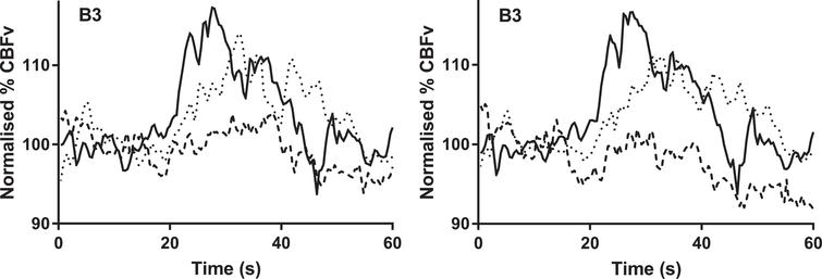 The temporal changes in cerebral blood flow velocity (normalized % CBFv) to the language task. All signals were normalized by baseline values. Continuous line = healthy control, dotted line = mild cognitive impairment. interrupted line = Alzheimer’s disease. a) non-dominant hemisphere; b) dominant hemisphere. Task initiation occurred at 20 s.