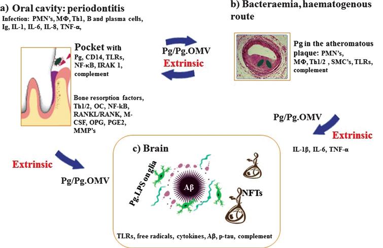 Schematic summary illustrates the extrinsic sources of inflammation involving periodontal and vascular pathologies to the brain including the local inflammation in each co-morbid state. a) Periodontitis: Body’s response is to initiate the innate immune defense mechanism. This results in recruitment of polymorphonuclear neutrophils (PMNs), which P. gingivalis uses as Trojan horses to enter below the gingivae. The host initiates P. gingivalis mediated inflammatory signaling pathways (lipopolysaccharide (LPS) receptor (CD14), and the highly conserved toll like receptors 2 and 4 (TLRs), nuclear factor κB (NF-κB), and the IL-1 receptor-activated kinase 1 (IRAK1). The bacterial proteases and LPS from the outer membrane vesicles (OMVs) directly damage connective tissues (elastin, fibrinogen, collagen) and the host cells also react by up regulating matrix metalloproteinases (MMPs) causing severe loss of host tissues. The humoral and adaptive immune response indicated by B-cells, plasma cells and T-cells (Th2) trigger immunoglobulin release and multiple cytokines (TNF-α, IL-1, IL-6, IL-8) and complement activation. The secretion of PGE2 and other cytokines NF-κB, receptor activator of NF-κB ligand (RANKL/RANK), macrophage colony stimulating factor (M-CSF) and osteoprotegrin (OPG) affect the alveolar bone homeostasis such that osteoclasts (OCs) begin bone resorption. b) Bacteraemias: PMNs and macrophages (MΦs) augment the expression of scavenger receptors in response to either local and/or extrinsic sources of inflammatory mediators and oral bacteraemia. Lipid-laden cells secrete proinflammatory cytokines, with recruitment of Th1/2 and MΦs within the atheromatous plaque where P. gingivalis lurks. Direct innate immune responses and additional cytokines and growth factors cause migration of smooth muscle cells (SMCs) and complement activation. c) Brain: The extrinsic factors from both periodontal disease and the vascular atheroma cause the initial trigger from systemic inflammation to affect the brain. This then leads to intracerebral inflammation (glia activated by P. gingivalis LPS from OMVs) leading to complement activation and emergence of hallmark proteins (Aβ and NFTs) that define Alzheimer’s disease.