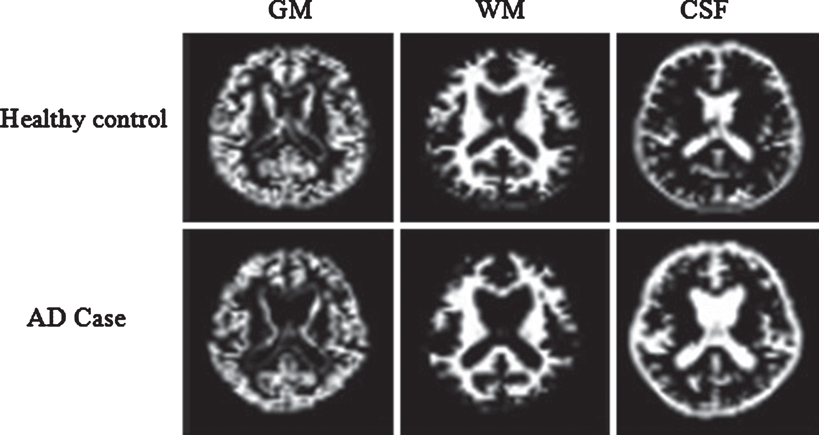 Segmentation results of a normal individual and an AD patient. AD, Alzheimer’s disease; GM, gray matter; WM, white matter; CSF, cerebrospinal fluid.