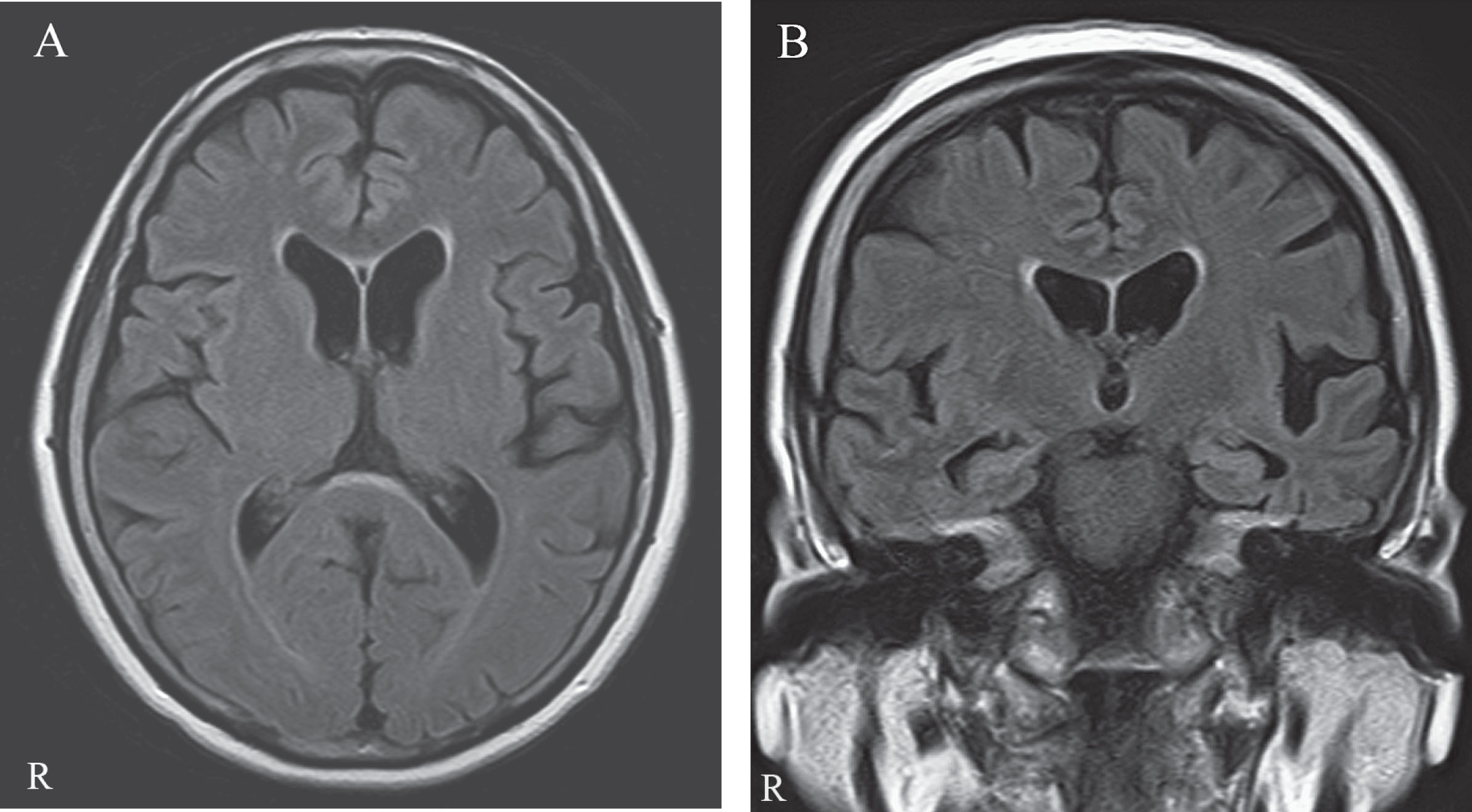 The MRI shows mild focal atrophy in the left posterior superior temporal and left inferior parietal junction regions. A) Axial FLAIR image. B) Coronal FLAIR image.