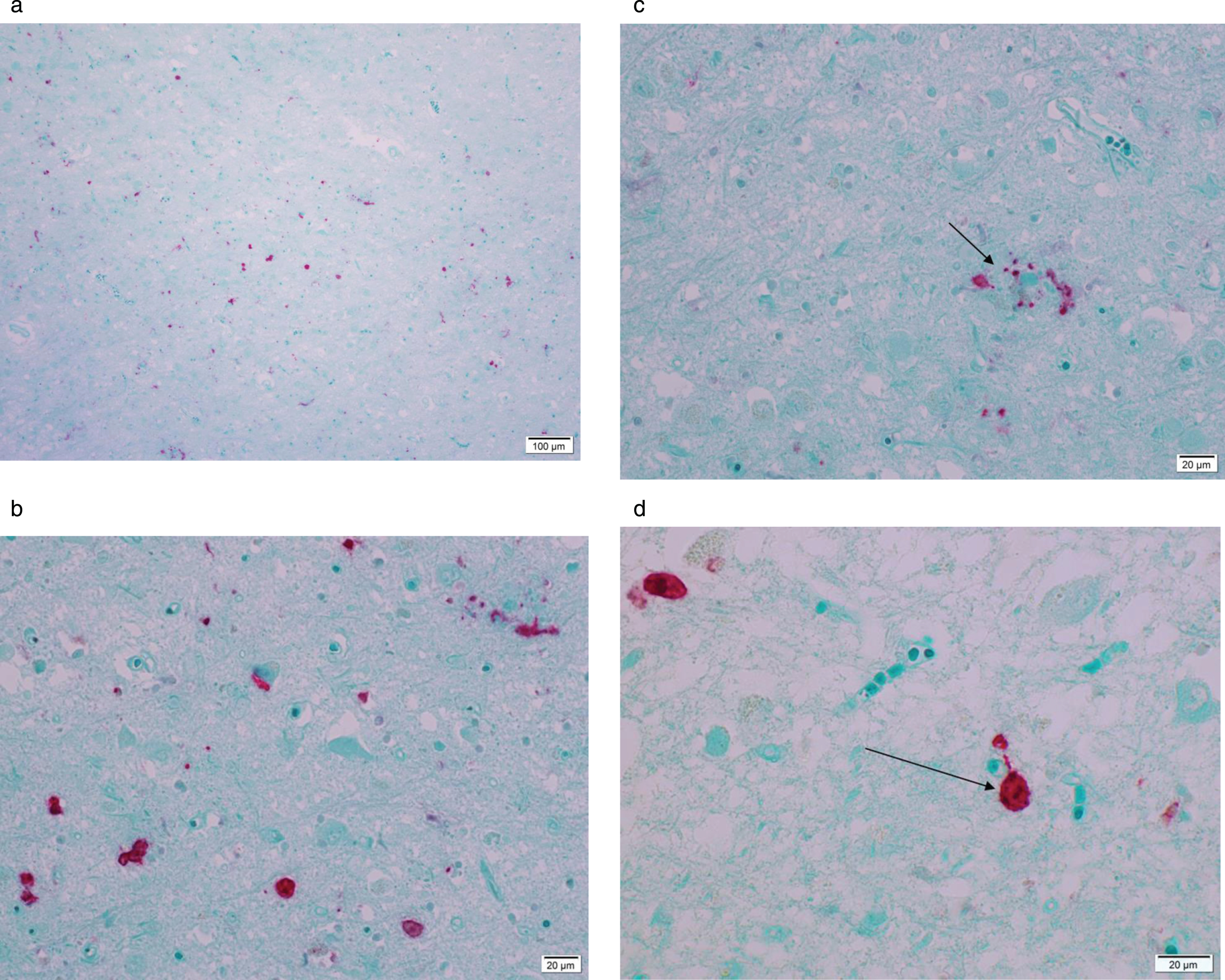 Microphotograph of formalin-fixed tissue from a 79-year-old patient diagnosed with Alzheimer’s disease staining positive using rabbit anti-Ljungan virus VP1 antibodies. Red stain visualizes presence of viral antigen. Panel A is an overview and Panel B is a magnification of the same region of the hippocampus. Red staining marks presence of viral antigen in neurons, astrocytes, and glial cells. In Panel C, an amyloid/neuritic plaque (marked with an arrow) in shown staining positive in the glial compartment and in dystrophic neurites. Panel D shows positive staining in neurons (marked with an arrow).