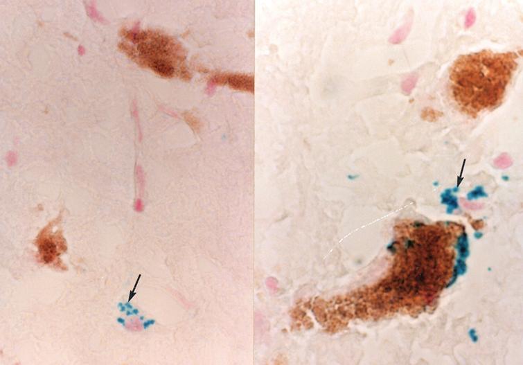 Frozen section of the human hypothalamus, stained to demonstrate iron via the Perl’s reaction and counterstained with neutral red to illustrate cell nuclei (see [40] for Perl’s stain methodology). Blue iron-rich cytoplasmic granules (arrows) are found in a Gomori-positive astrocyte (left side of figure). On the right side of the figure, a Gomori-positive astrocyte is in close contact with a catecholaminergic neuron filled with neuromelanin.
