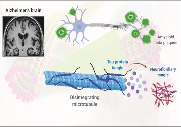 Representation of formation of amyloid-β plaques and neurofibrillary tangles.