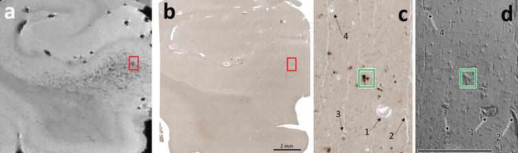 Correlative MRI (a), optical microscopy (b, c), and SEM (d) demonstrating presence of iron deposits in specimen A5. a) MRI hypointensities can be seen throughout the subiculum, as marked by the red box. b) Iron-positive staining can be seen on optical microscopy. These iron deposits coregister with the hypointensities in the visually aligned MRI in (a). The region indicated by the red box was selected for further analysis. c) Higher-resolution optical microscopy of the boxed region in (a) and (b) demonstrates clear iron-positive foci. d) SE-SEM micrographs of the boxed region in (a) and (b). The numbered features 1–4 demonstrate example fiducial markers found within the specimen and can be found at the same positions in both images. The location of a dark stained region in the optical micrograph (green box) was identified in the SEM for energy dispersive X-ray spectroscopy to identify the elements present.