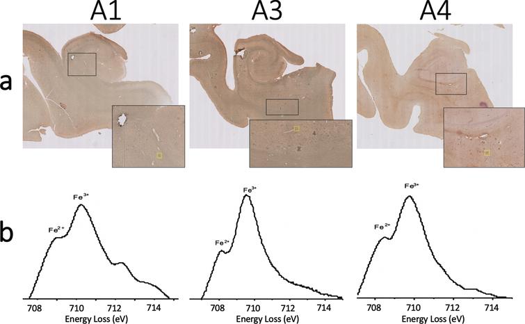 a) Iba-1 and ferritin immunohistochemistry double stain and (b) monochromated EELS spectra of the iron rich regions shown in yellow box from (a) for specimens A1 (left), A2 (center), and A3 (right). Splitting of the L3 peak of iron suggests the presence of Fe