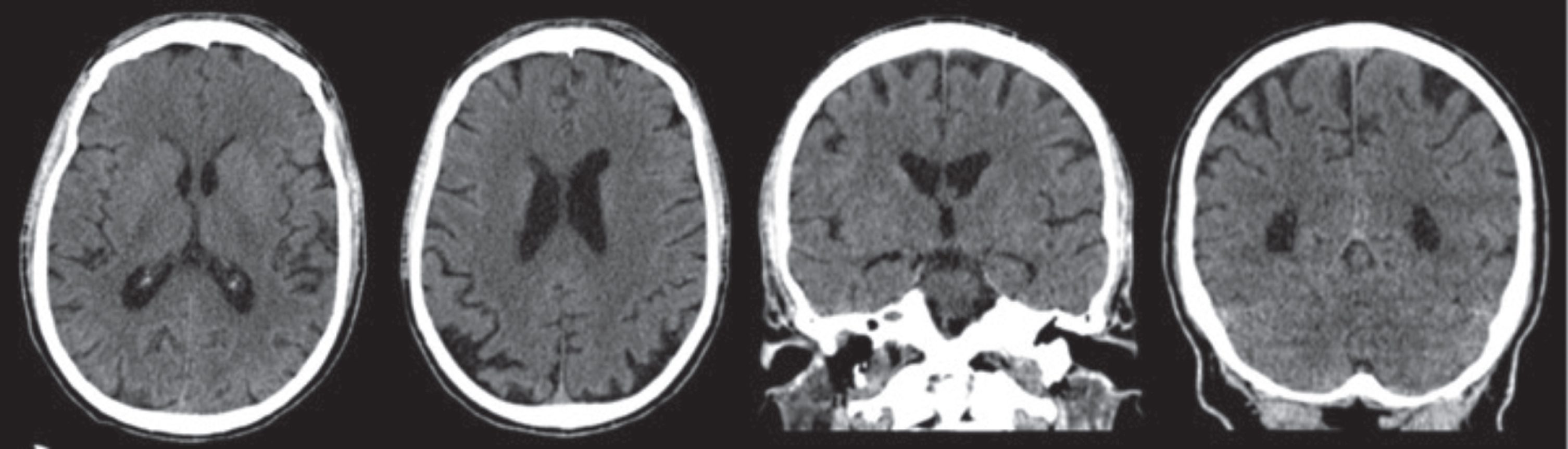 CT scan (December 18, 2018), with no contrast, showing a modest enlargement of subarachnoid spaces of the vault with bilateral parietal cortical atrophy and atrophy of posterior cortex especially in the higher sections. The hippocampus and the mesial temporal area appear fairly preserved. Sagittal section not available.