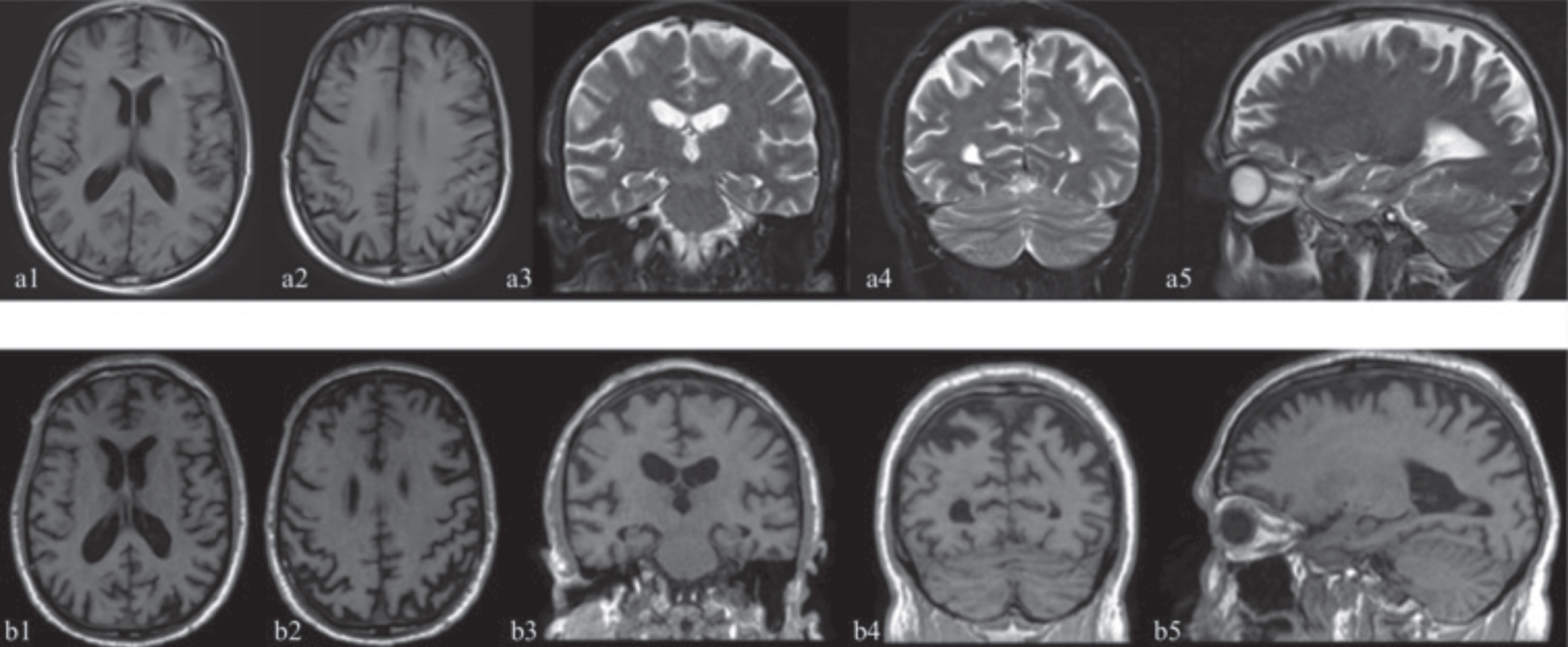The first MRI study (January 12, 2019) is illustrated by the images above (a1-a5) while the second study (December 22, 2020) produced the images below (b1-b5). (a1, a2, b1, b2 axial sections; a3, a4, b3, b4 coronal sections; a5, b5 sagittal sections). Not available T1 sequences in the first study in the coronal and sagittal projections. Structural MRI T1 and T2 weighted sequences reported subarachnoid spaces of the vault enlarged in the fronto-parietal region (b1, b2, a3, b3, a5, b5), anterior (b2, a5, b5) and posterior cortical atrophy especially in the higher sections (a2, b2, a4, b4) and minimal gliotic alterations within the right-hemisphere’s white matter. The hippocampus and the mesial temporal area appear fairly preserved (a3, b3). The comparison between the two studies shows an increase in frontal (b2) and posterior (b2, b4) atrophy after 23 months.
