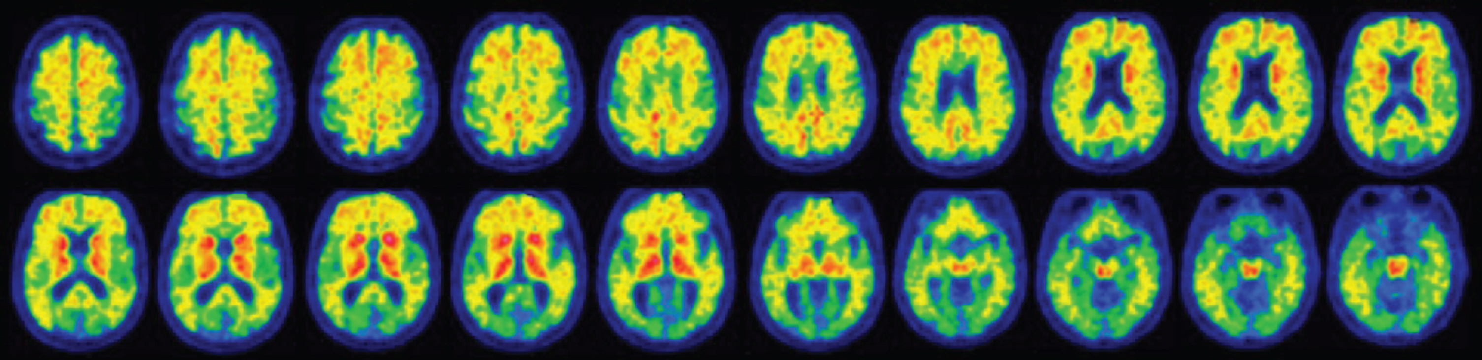 18F-Flutemetamol PET scan highlighting a diffused uptake of the amyloid tracer at the level of the cerebral cortex, particularly in the frontal lobes, parietal lobes, lateral temporal lobes, in the posterior cingulate, bilaterally and in correspondence of the striate nuclei.